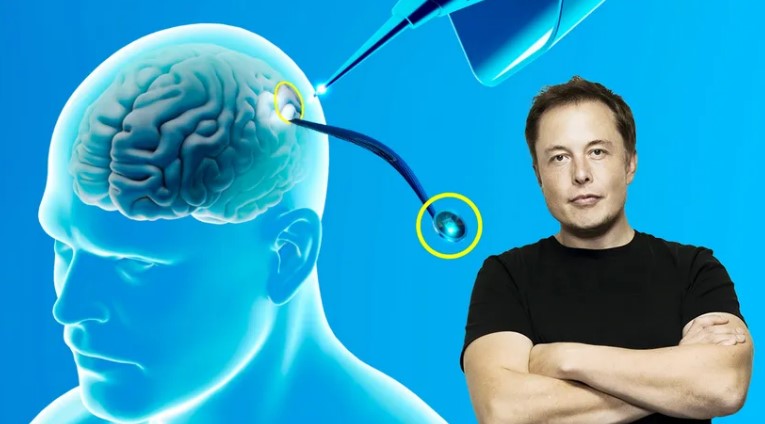 El Chip De Neuralink Implantado En El Primer Paciente Se Est Soltando