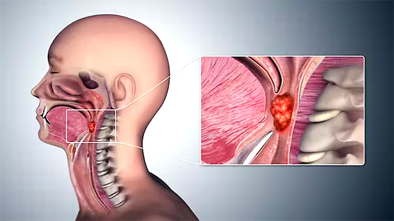 Cáncer de garganta