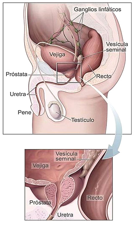 Cáncer de próstata 