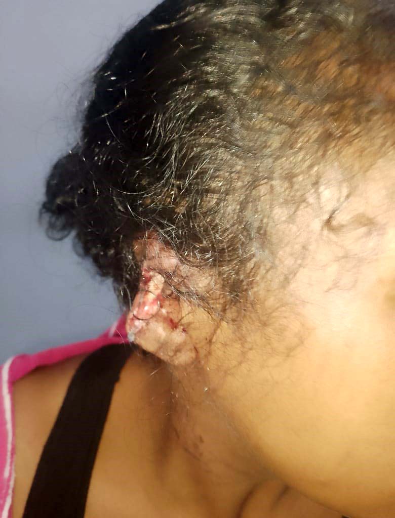 Atacó a mordiscos a su pareja y le quitó parte de la oreja